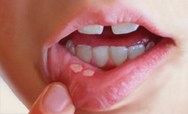 Thay đổi màu sắc da môi là một dấu hiệu khác của ung thư môi. Ảnh: ungthuvietnam.