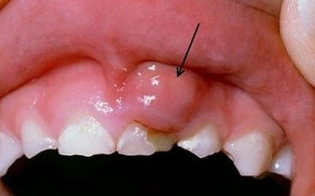 Khi bị ung thư môi, hiện tượng đột nhiên răng lung lay, rụng cũng có thể xuất hiện. Khi nhai đồ ăn sẽ cảm thấy khó khăn, vùng khoang mũi họng tê, đau. Ảnh: cafefcdn.