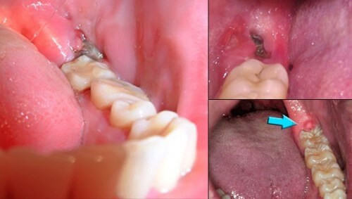 Hút thuốc sẽ khiến máu đông bị nới lỏng và kéo dài thời gian lành vết thương. Ảnh: media.