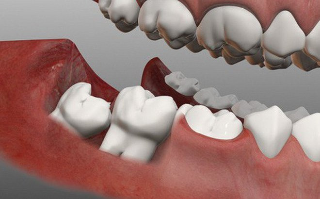 Trong suốt thời gian điều trị nhổ răng khôn, bạn tuyệt đối không được uống rượu. Ảnh: amazonaws.