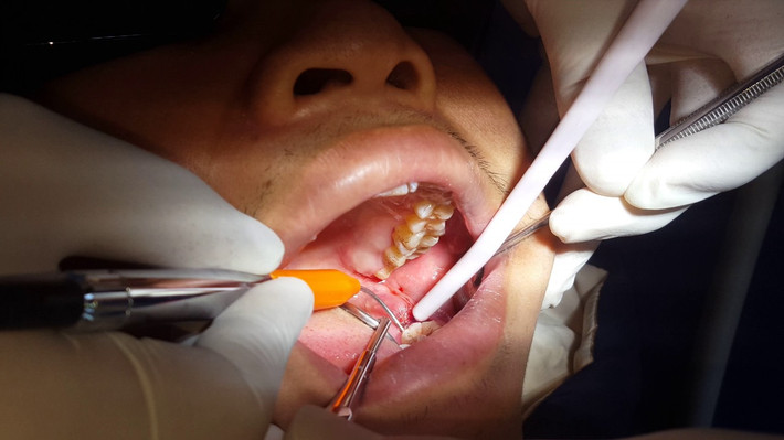 Lúc này, bạn có thể sử dụng túi đá lạnh để chườm lạnh khoảng 10 – 15 phút/lần sẽ giảm sưng. Ảnh: ytimg.