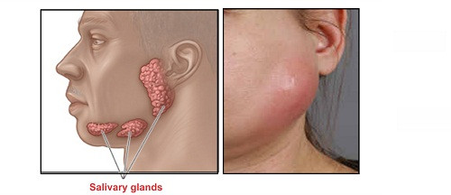 Dùng ngoài trị viêm tuyến mang tai, mụn nhọt, đòn ngã tổn thương gẫy xương, giã cây tươi đắp tại chỗ. Ảnh: benhquaibi.net.
