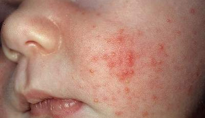 2. Bệnh hạt kê ở trẻ. Mụn kê thường xuất hiện trên má, đôi khi ở trên trán, cằm, chân tay và cả lưng. Những nốt mụn này có thể bị bao bọc bởi một vùng da hơi tấy đỏ và sẽ càng đỏ tấy hơn khi cơ thể bé nóng lên hay khi da bị kích thích do tiếp xúc với nước bọt, sữa mẹ cũng như các chất tẩy rửa. Ảnh: Conlatatca.vn.
