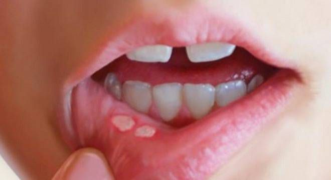 3. Nước chiết mướp đắng ướp đường: Mướp đắng tươi 1 – 2 quả. Mướp đắng rửa sạch, nghiền nhuyễn, cho thêm 100g đường trắng trộn khuấy đều để sau 2 giờ đem khuấy nước sôi nguội và lọc lấy nước cho uống 1 lần. Dùng cho chứng nhiệt lỵ. Ảnh: BonKid.com.vn.