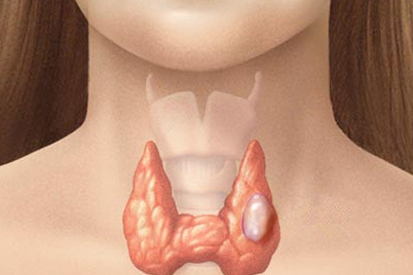 6. Bị viêm họng hạch: Nguyên nhân là do họng hạch của bé dưới một tuổi vẫn chưa phát triển hoàn toàn. Thêm vào trong nước bọt của người lớn đang bị viêm họng hạch có chứa một lượng lớn các vi khuẩn như tụ cầu khuẩn, liên cầu khuẩn v.v Ảnh: dominhduong.vn.