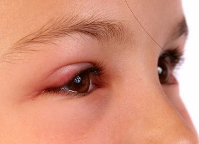 5. Bị viêm kết mạc: Trong ghèn mắt, nước mắt của người bị viêm kết mạc đều có chứa vi khuẩn gây bệnh, ngoài ra tay cũng có thể dính chất ô nhiễm mang mầm bệnh, khi bạn ôm hôn hay gần gũi với bé sẽ khiến các vi khuẩn này có cơ hội tấn công sang cơ thể non yếu của bé. Ảnh: alobacsi.com.
