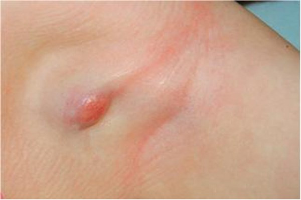 2. Khi bạn bị nổi mụn nước, nhọt hay cách hạch mủ: Chất dịch có mầm bệnh từ những mụn nước của người bệnh có thể truyền sang cơ thể bé khi hôn hoặc tiếp xúc cơ thể. Ảnh: trimunboc.com.vn.