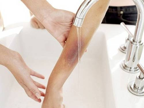 5. Điều trị bỏng nhẹ: Dùng một chút dầu gió bôi mỏng lên lớp da bị bỏng nhẹ, mỗi ngày thực hiện một lần, bôi liên tiếp ít ngày sẽ nhanh chóng hồi phục vết thương. Ảnh: Nacurgo.com.