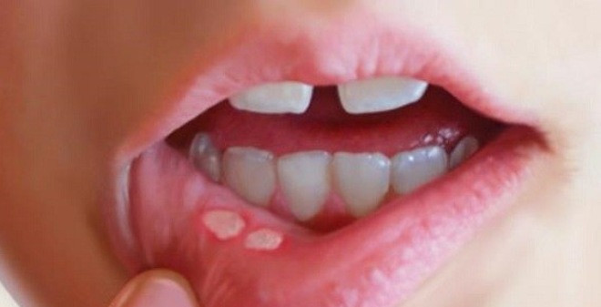 1. Chữa viêm loét miệng: Sau khi đánh răng, vệ sinh miệng hoặc súc miệng sạch sẽ, sau đó chấm nhẹ chút dầu gió vào vết thương, mỗi ngày bôi 2 lần, trước khi ngủ bôi 1 lần thì hiệu quả sẽ càng tốt. Ảnh: soha.vn.