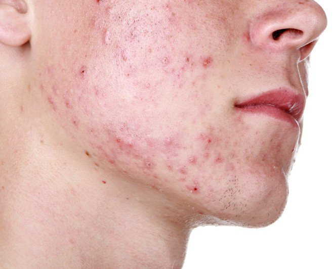 3. Trị mụn: Khi trên mặt xuất hiện mụn thì hãy thoa nước cơm lên rồi 5 phút sau rửa sạch lại. Thành phần của nước cơm sẽ giúp giảm sưng đỏ, vết mụn sẽ dễ lành hơn. Ảnh: ViCare.vn.