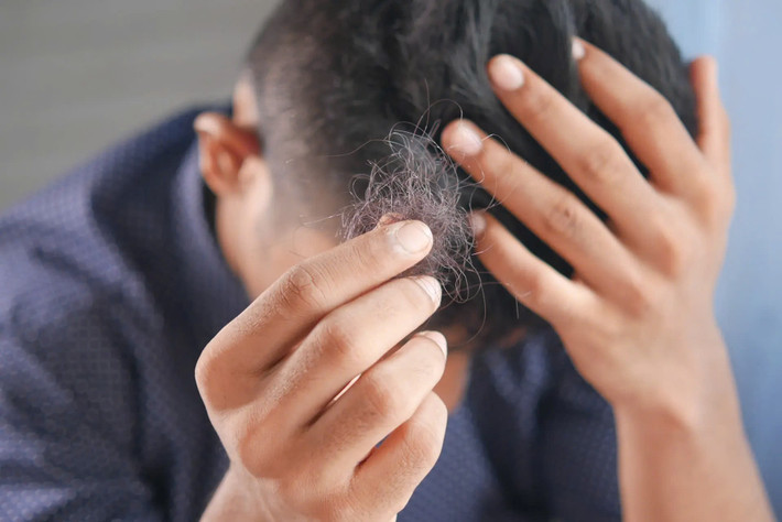 Rụng tóc: Hói đầu là một phần tự nhiên của quá trình già hóa ở nhiều đàn ông. Tuy nhiên, nam giới thiếu testosterone có thể bị rụng tóc và rụng lông trên cơ thể. Ảnh Geneworld