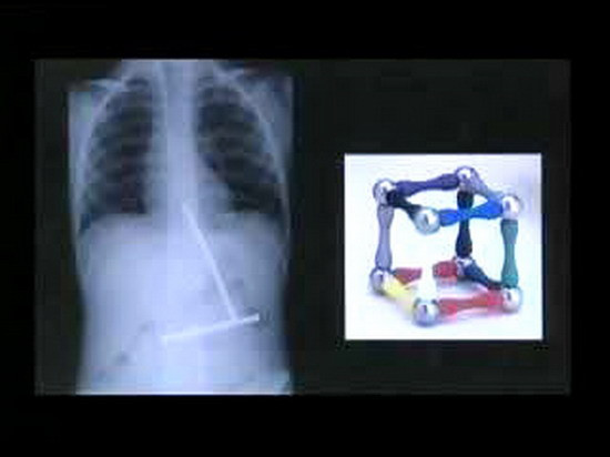 Phim chụp X_quang này cho thấy cậu bé đã nuốt những thanh nam châm rời nhau của một khối hình. Khi các bác sĩ phẫu thuật thì các thanh nam châm đã ghép lại với nhau.