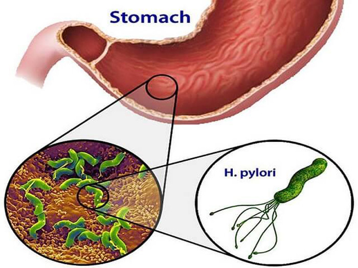 Ở trong cơ thể, H.P sản xuất catalase, protease, ngoại độc tố... làm tổn thương niêm mạc dạ dày, gây viêm dạ dày hoặc loét dạ dày tá tràng. Ở một số người nếu vi khuẩn ở trong dạ dày thời gian dài nhiều năm có thể gây ung thư dạ dày. Ước tính, khoảng 65 - 80% số trường hợp ung thư dạ dày có liên quan đến H.P. Ảnh: Internet.