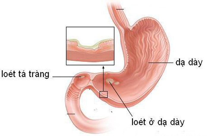 Loét dạ dày. Viêm loét dạ dày là tổn thương gây viêm và loét trên niêm mạc dạ dày. Những tổn thương này xảy ra khi lớp niêm mạc bảo vệ cuối cùng của dạ dày bị bào mòn làm cho lớp mô bên dưới bị lộ ra. So với các bệnh dạ dày khác, viêm loét dạ dày được đánh giá “gần” với ung thư nhất.