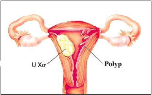 Hiện tượng chảy máu bất thường xuất hiện ở tuổi 40 có thể là triệu chứng của polyp tử cung. Mặc dù buồng trứng so với trước đây không còn rụng trứng đều đặn theo quy luật và tần suất rụng trứng cũng giảm đi nhiều nhưng cũng không thể bỏ qua các vấn đề ngừa thai. Tỷ lệ mang thai ngoài ý muốn ở phụ nữ 40 tuổi cũng cao ngang bằng so với mang thai ngoài ý muốn ở tuổi thanh niên.