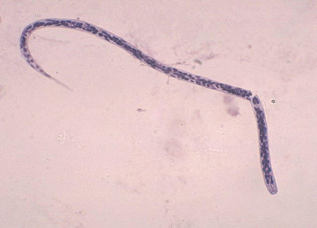 Bệnh giun chỉ Onchocerca volvulus dẫn đến tình trạng viêm nhiễm nghiêm trọng trong mắt, làm tổn thương các cấu trúc quan trọng và thường gây mù vĩnh viễn. Ký sinh trùng này được truyền bởi loài ruồi đen sống gần nơi có nước. Chúng chích vào da và truyền những con giun chưa trưởng thành. Ấu trùng trưởng thành tạo ra hàng ngàn ấu trùng nhỏ gọi là vi giun chỉ, định cư khắp cơ thể. Khi đến mắt, chúng có thể gây viêm, tạo sẹo ở giác mạc và các mô sâu hơn của mắt bao gồm màng mạch và dây thần kinh thị giác.