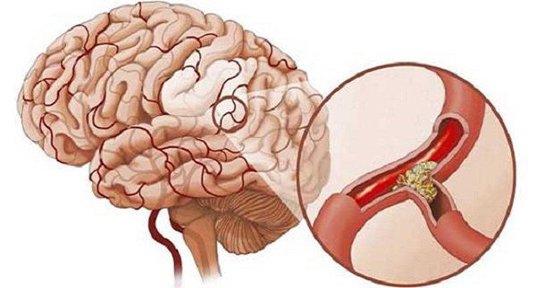 Được biết, nhồi máu não là tình trạng mạch máu não tắc nghẽn do huyết khối. Nếu không điều trị kịp thời, bệnh có thể để lại di chứng nghiêm trọng như liệt nửa người, mất ngôn ngữ, thậm chí đe dọa tính mạng. Ở Trung Quốc, mỗi năm có khoảng 2 triệu người mất vì căn bệnh. Nó cũng khiến 75% người sống sót mất khả năng lao động ở các mức khác nhau, 4% tàn tật nặng.