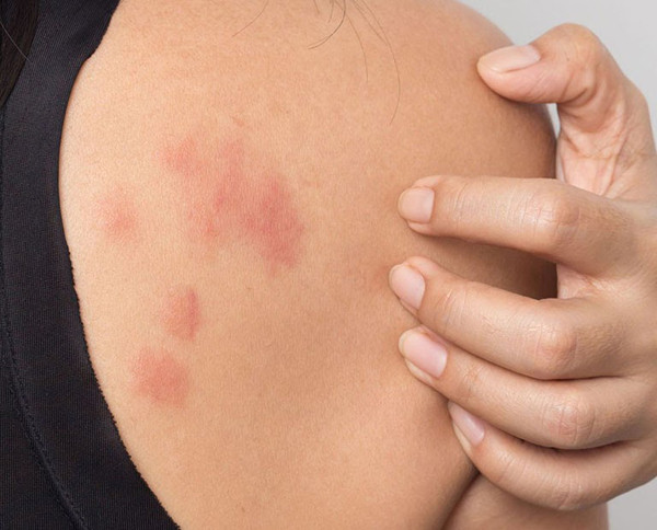 Thực tế, lượng formaldehyde được tìm thấy ở loại vải không nhăn khó có khả năng gây khó chịu với hầu hết mọi người. Vậy nhưng, tùy vào cơ địa, người có tiền sử dị ứng có thể đối diện viêm da. Biểu hiện của dị ứng formaldehyde là tình trạng mọc ban, mụn nước, da bong tróc, khô, ngứa. (Ảnh minh họa)