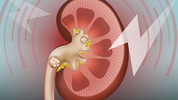 Không chỉ gây đau đớn cho người bệnh, sỏi thận nếu không được phát hiện và điều trị kịp thời có thể dẫn đến biến chứng suy thận. Để ngăn ngừa mối nguy từ sỏi thận, bác sĩ đặc biệt nhấn mạnh tầm quan trọng của việc duy trì thói quen ăn uống lành mạnh. Cố gắng tránh xa 4 cách ăn dễ gây sỏi thận dưới đây.