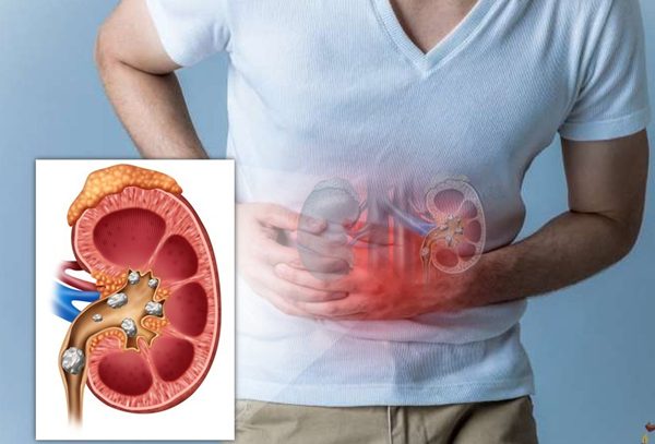 Thận có vị trí nằm dưới khung xương sườn, ở hai bên cột sống, tựa vào các cơ của lưng. Tùy vào kích thước của viên sỏi, nó có thể làm cản trở đường dẫn nước, tăng áp lực cho thận dẫn đến các cơn đau. Điều này giải thích vì sao người bị sỏi thận thường có cảm giác đau vùng thắt lưng.