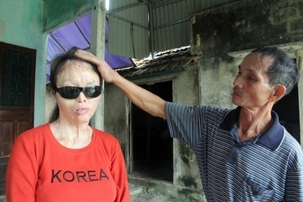 Sau khi giáo viên này gặp nạn, gia đình đã khánh kiệt vì tiền chữa trị nhưng chị Lương vẫn bị mù lòa.