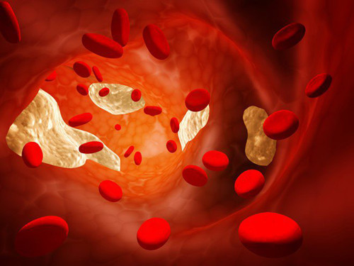 Tăng cholesterol. Kết quả nghiên cứu chỉ ra, người bỏ bữa sáng có lượng cholesterol cao hơn nhiều so với người dùng bữa sáng đều đặn. Đáng lưu ý, trẻ em có lượng cholesterol cao đều có các vệt mỡ trong mạch máu. Đây là dấu hiệu sớm của bệnh xơ vữa động mạch.