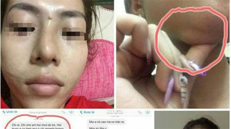 Bơm chất độn vào mũi, cằm. Thẩm mỹ bằng phương pháp tiêm chất làm đầy đang được rất nhiều người ưa chuộng thay vì phải phẫu thuật dao kéo như trước đây. Theo như nghiên cứu ở Việt Nam hiện nay chỉ có một số chất làm đầy như Radiesse, Juverderm và Restylane… được chứng nhận chất lượng và cho phép lưu hành.