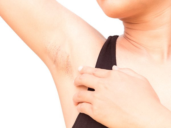 Cạo lông ở vùng nách Hãy giữ cho vùng da dưới cánh tay được sạch lông. Da ở vùng nách có nhiều lỗ chân lông tự nhiên giúp giữ độ ẩm cũng như ngăn ngừa tác dụng phụ của các chất chống tiết mồ hôi. Cạo hoặc tẩy lông ở vùng da dưới cánh tay bằng sáp hoặc kem tẩy lông sẽ giúp giữ cho da sạch và tiết ít mồ hôi. Đây là một trong những cách hiệu quả nhất để làm giảm tiết mồ hôi ở nách.