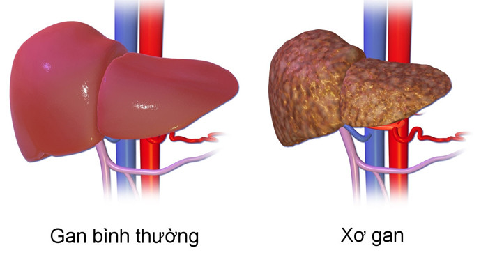 Theo chuyên gia sức khỏe, xơ gan là bệnh mãn tính, tiến triển nặng dần theo thời gian nên việc phát hiện, điều trị sớm có ý nghĩa quyết định.