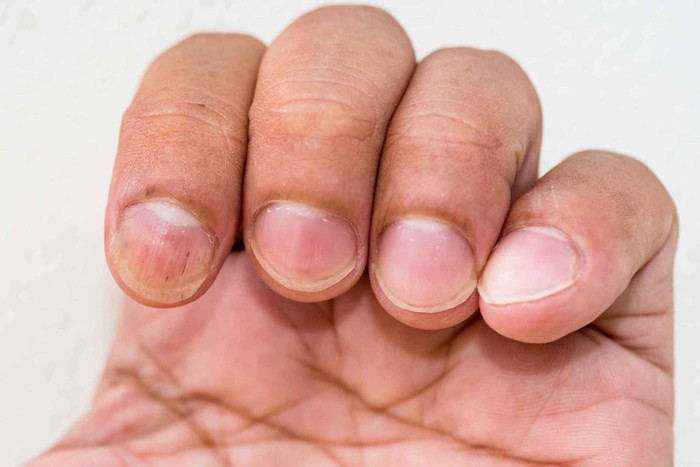 Móng tay lưỡi liềm. Mắc chứng xơ gan, quá trình trao đổi chất cơ thể không được vận hành như bình thường, ảnh hưởng quá trình tổng hợp protein. Một khi lượng protein cung cấp cho cơ thể suy giảm, điểm bất thường trên móng là xuất hiện các vết nứt nhỏ như lưỡi liềm, trở nên xỉn màu không bắt mắt.