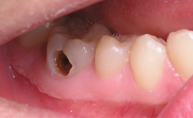 Người bị sâu răng. Tác hại của nước đá thể hiện ở việc khiến răng sâu của bạn bị ê buốt đồng thời ảnh hưởng tới men răng, khiến sức đề kháng của răng bị giảm từ đó phát sinh ra các bệnh về răng miệng.