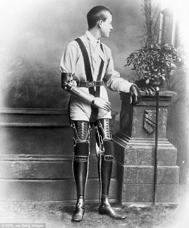 Đến năm 1920, người thợ giày Gillingham đã dùng những đôi chân tay giả này để phục hồi chức năng cho hơn 15.000 bệnh nhân.