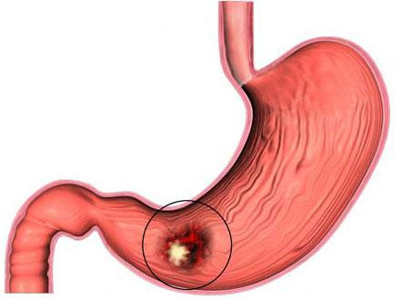 Viêm loét dạ dày. Khi sử dụng liều cao Aspirine và những loại thuốc kháng viêm không steroidal (non - steroidal anti - inflammatory drugs - NSAIDS) có thể gây tổn hại các màng nhầy ở dạ dày và hệ tiêu hóa trên tạo nên sự viêm loét, xuất huyết ở hệ tiêu hóa. Sự lở loét đường tiêu hóa thường gây ói mửa, sụt cân, những trường hợp nghiêm trọng cần được can thiệp bằng phẫu thuật.