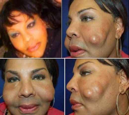 Cô Rajee Narinesingh, 48 tuổi, sống ở Florida, Mỹ cũng là một trong những nạn nhân của bác sĩ rởm đã đã bơm xi-măng vào mặt đến biến dạng.
