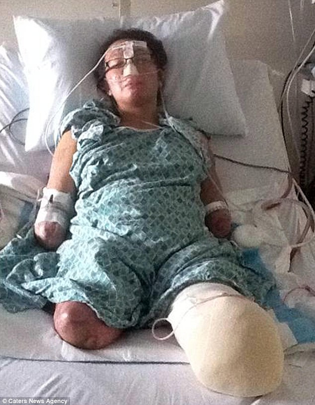Karen Crespo, 32 tuổi, đến từ Los Angeles mắc bệnh viêm màng não đã phải cắt cụt tay chân mới mong cứu được mạng sống.