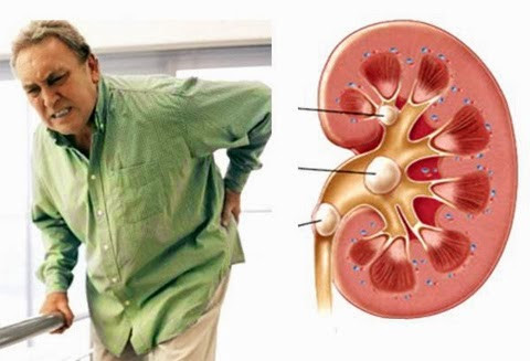 Bệnh sỏi thận. Khi bạn cảm thấy đau lưng ở vùng hông bên trái hoặc bên phải phía trên vùng thắt lưng, cảm giác nhói đau từ lưng lan xuống vùng bụng dưới có thể là sỏi thận. Đối với trường hợp này bạn cũng nên đến cơ sở y tế để được bác sĩ chuẩn đoán và cấp thuốc.