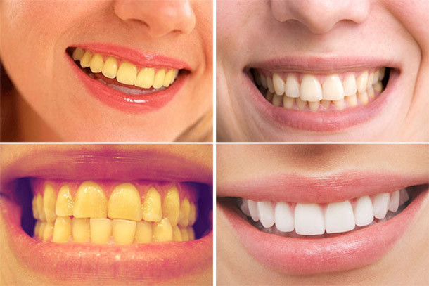 Ngoài ra, bạn có thể lấy khoảng 1-2 thìa dầu dừa nguyên chất và ngậm trong miệng chừng vài phút. Sau khi ngậm vào dầu dừa nguyên chất một lượng vừa đủ, bạn tiến hành súc miệng liên tục để tinh chất dầu dừa giúp làm sạch các mảng bám, vết ố vàng trên răng và sau đó súc miệng lại với nước sạch.