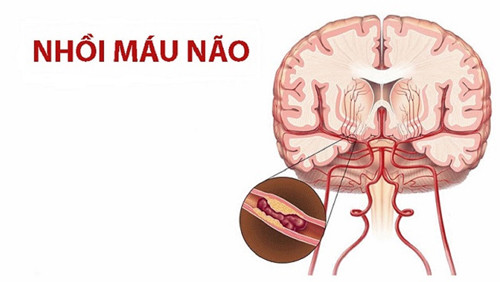 Nhồi máu não là bệnh có tỷ lệ mắc ngày càng cao. Bệnh khởi phát nhanh, nếu không cấp cứu trong thời gian ngắn dễ gây hậu quả nghiêm trọng như liệt nửa người, liệt, sa sút trí tuệ, thậm chí đe dọa tính mạng. (Ảnh minh họa)