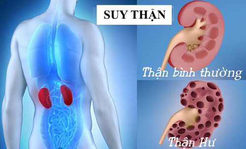 Điều đáng bàn, thói quen sinh hoạt không khoa học cùng các yếu tố môi trường khiến ngày càng có nhiều người mắc các bệnh về thận. Ở đó, suy thận là tình trạng thận bị mất chức năng, không còn khả năng lọc các chất thải từ máu. Điều này dẫn đến những chất thải trong máu không thể lọc ra ngoài và tích tụ lại trong cơ thể.