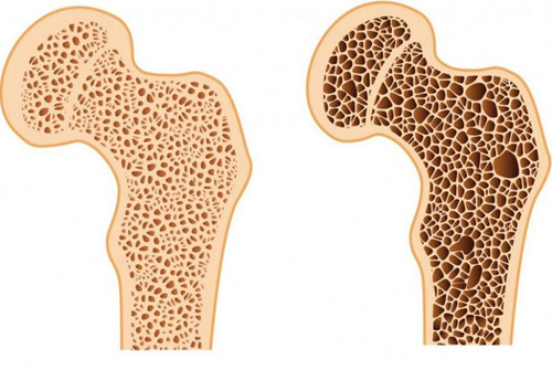 Loãng xương. Ngoài nguyên nhân mệt mỏi, người bị loãng xương, giảm estrogen ở phụ nữ lớn tuổi cũng dễ đối diện tình trạng chuột rút về đêm. Điều này bắt nguồn từ lượng canxi trong máu thấp, gây tăng căng cơ, dễ co thắt.