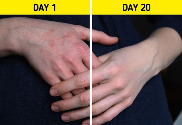 Vitamin B3 còn được ví như hàng rào bảo vệ da, duy trì độ ẩm cực nhạy. So với việc sử dụng các loại kem bôi ngoài da có kết quả sau vài tuần, vitamin B3 sẽ mang lại hiệu quả trong thời gian rất ngắn. Ảnh: BS, Internet.