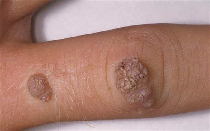 Mụn cóc là những khối u nhỏ sần sùi do virus lây qua đường sinh dục gây nên. Chúng có thể xuất hiện ở bất cứ vùng da nào, chúng gây mủ khiến chủ nhân ngứa ngáy khó chịu. Chính vì thế, ngay khi mới xuất hiện, bạn nên điều trị chúng ngay. Dưới đây là mẹo trị mụn cóc sinh dục từ nguyên liệu trong bếp hiệu quả mà không hề tốn kém, lại được nhiều người áp dụng thành công. Ảnh: Muncocsinhduc.