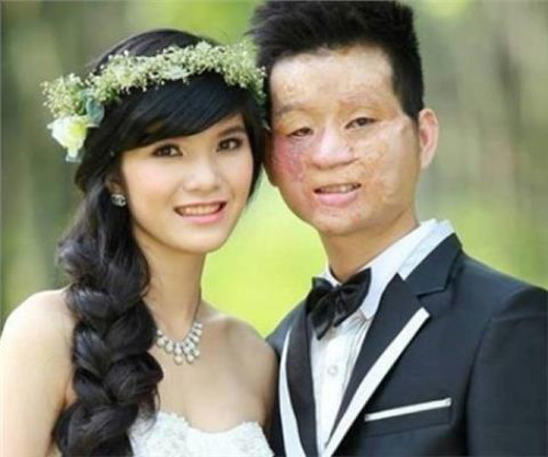 Bức ảnh cô dâu xinh đẹp tươi cười rạng rỡ bên cạnh chú rể có gương mặt bbiến dạng đã khiến nhiều cư dân mạng xúc động. Trên một fanpage, bức ảnh này đã nhận được gần 400 ngàn lượt like và hơn 3 ngàn lượt chia sẻ.