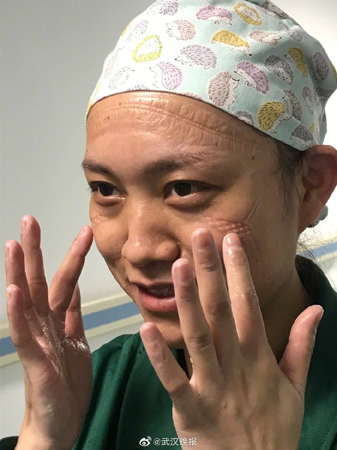 Thậm chí, nhiều dân mạng còn dân chứng do đeo khẩu trang bảo hộ trong một thời gian dài nên trên gương mặt tất cả nhân viên y tế đều xuất hiện vệt hằn chằng chịt. Điều này cho thấy công việc đánh đuổi virus Corona của các bác sĩ tại Vũ Hán căng thẳng đến thế nào. Nguồn ảnh: Weibo.