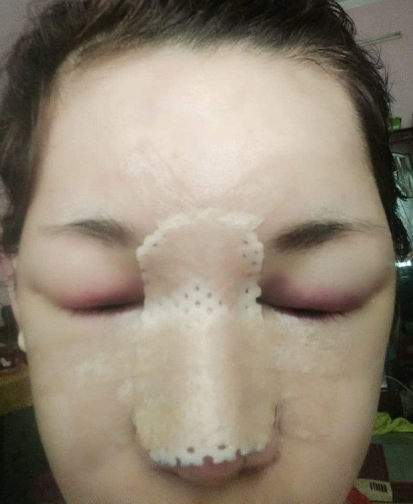 Cô gái này quyết tâm "dao kéo" mũi, tiêm má, môi, cằm.