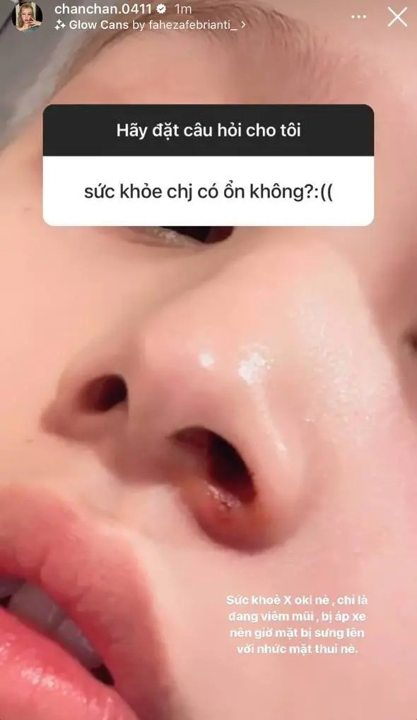 Theo Xoài Non chia sẻ, cô bị viêm, áp xe ở mũi nên khi đi khám, bác sĩ nhận thấy tình trạng có vẻ nặng nên yêu cầu nhập viện để tiêm thuốc. Nếu vẫn không thuyên giảm sẽ có thể phải mổ và truyền thuốc. Tuy vậy khi người theo dõi lo lắng, cô nàng vẫn cố giữ thái độ tích cực và trấn an rằng sức khỏe vẫn ổn.