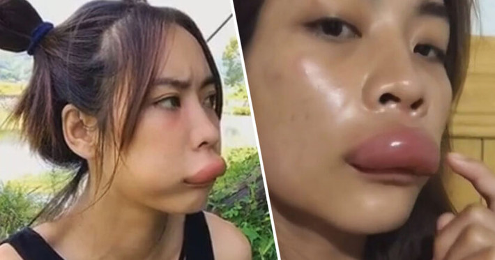 Cô gái sau đó nói miệng của mình “đau như chết đi sống lại” và bất cứ khi nào cô cố gắng uống nước thì nước sẽ bị rò rỉ ở khóe miệng. Mặc dù đây là một trải nghiệm đáng sợ nhưng may mắn thay tình trạng của cô gái không được cho là nguy hiểm tới tính mạng.