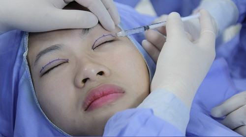 Đầu tiên, bác sĩ định hình vùng mí cần xử lý, sát khuẩn vùng mặt, đặc biệt là vùng mắt. Sau đó tiến hành gây tê vùng mí mắt. Thực tế của việc phẫu thuật mí mắt là tạo ra một nếp gấp nữa trên mí. Ảnh: catmimat