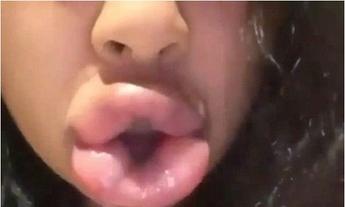 Đôi môi hỏng, sưng vù và mọng đỏ lên vì bị dồn máu. Ảnh: vietgiaitri