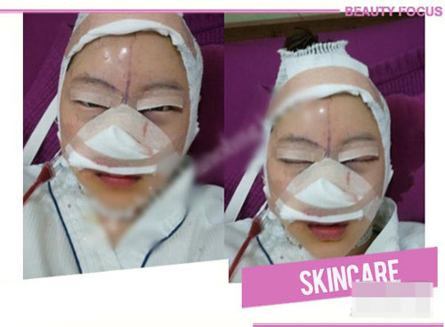 Khuôn mặt băng bó chằng chịt, sưng húp khiếp sợ của cô gái Hàn Quốc sau phẫu thuật sữa mũi và các bộ phận khác. Ảnh: beauty